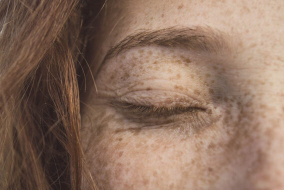 Can Freckles Be Fixed?