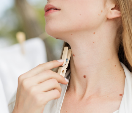 Celebrate Skin Cancer Awareness Month by Getting a Mole Evaluation
