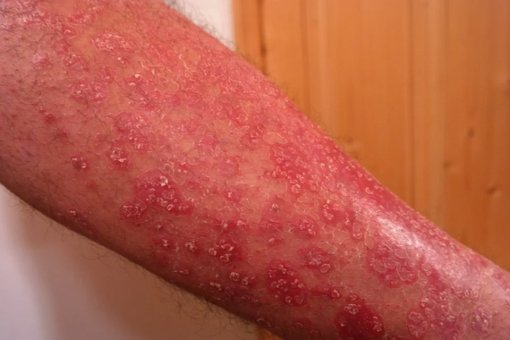 How to Treat and Prevent Hives