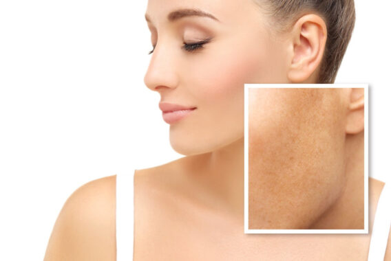 Pigmented Spots: Is Laser Treatment for Melasma Safe?