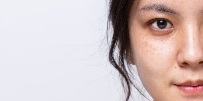 Can You Really Get Rid of Freckles?