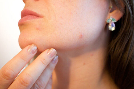 Can Diet Affect Acne?