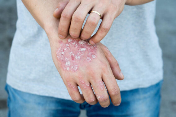 Diagnosed With Psoriasis? Try These Winter Skin Tips