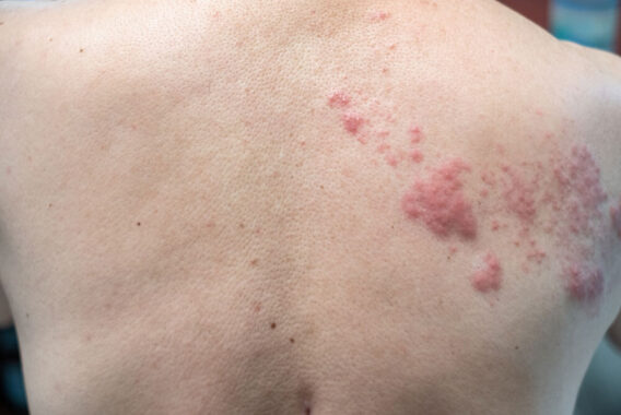 Risk Factors and Treatment Options for Herpes Zoster (Shingles)