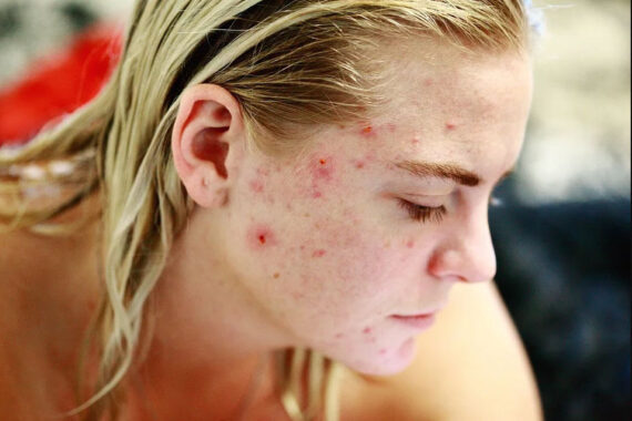 Skin Conditions: Do I Have Acne or Sebaceous Cysts?
