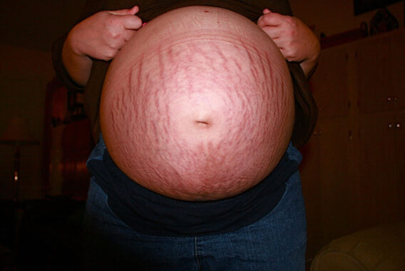 Stretch Marks: How Lasers Can Help